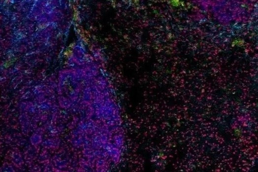 Loai virus co co the la chia khoa de dieu tri ung thu phoi