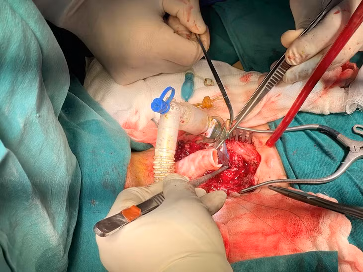 Lần đầu tiên Việt Nam ghép khí quản và phẫu thuật tạo hình thực quản hẹp hiếm gặp trong y văn - Ảnh BVCC