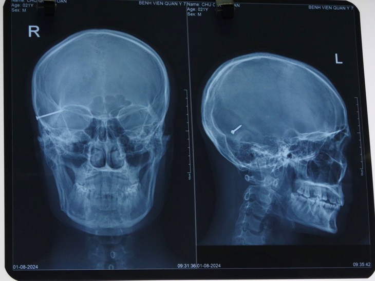 Dị vật kim khí trong sọ bệnh nhân trên phim chụp - Ảnh BVCC