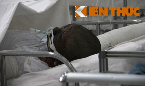 Nạn nhân Nam bị phỏng nặng 67%, độ 2, 3 có nguy cơ phỏng hô hấp đang cấp cứu tại phòng cách ly.