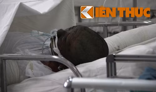 Nạn nhân Nam bị phỏng nặng 67%, độ 2, 3 có nguy cơ phỏng hô hấp đang cấp cứu tại phòng cách ly.