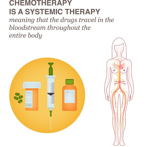 Điều trị ung thư vú bằng phương pháp hóa trị liệu.
