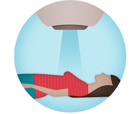 Điều trị ung thư vú bằng xạ trị.