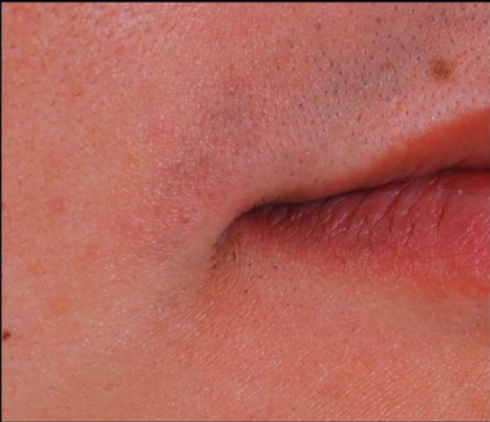 Khóe miệng tự nhiên chưa thẩm mỹ.