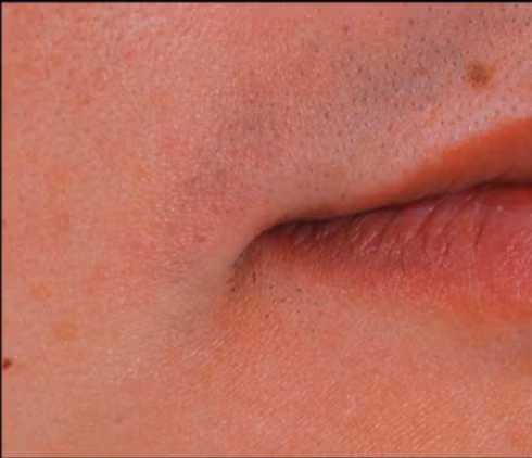 Khóe miệng tự nhiên chưa thẩm mỹ.