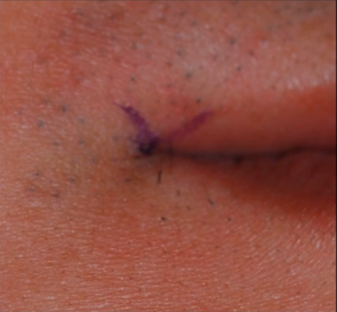 Các bác sĩ tiến hành đánh dấu phần cơ họ sẽ can thiệp.