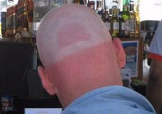 Dấu vết của chiếc mũ.