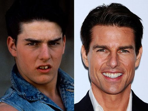 Tom Cruise chắc khó lòng mà tỏa sáng trên màn ảnh nếu cứ giữ bộ răng cửa thò ra thụt vào như ngày xưa.