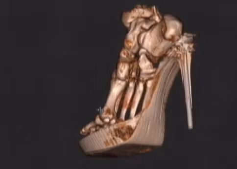 Phần xương chân bị tổn thương do đi giày cao gót được minh họa bằng hình ảnh 3D.