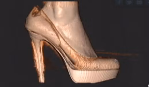 Với sự trợ giúp của máy quét, các chuyên gia tại bệnh viện đã có thể thấy rằng mang chiếc giày cao gót buộc bàn bàn chân phải ép vào một hình dạng không tự nhiên.