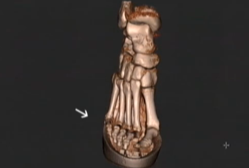 Đi giày cao gót khiến đôi chân bạn không được tự do, xương bàn chân bị ép theo khuôn dẫn đến dễ bị dị dạng.