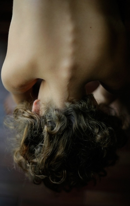 Cận cảnh xương sống của Hannah cong vẹo.