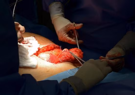 Các bác sĩ đang tiến hành phẫu thuật gan cho bệnh nhân, gan, một trong những ca phẫu thuật nội tạng đầu tiên ở Đức với sự hỗ trợ của một máy tính bảng để truy cập và hiển thị dữ liệu.