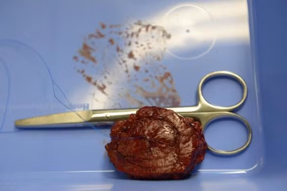 Một khối u đã được cắt bỏ khỏi gan trong quá trình phẫu thuật.