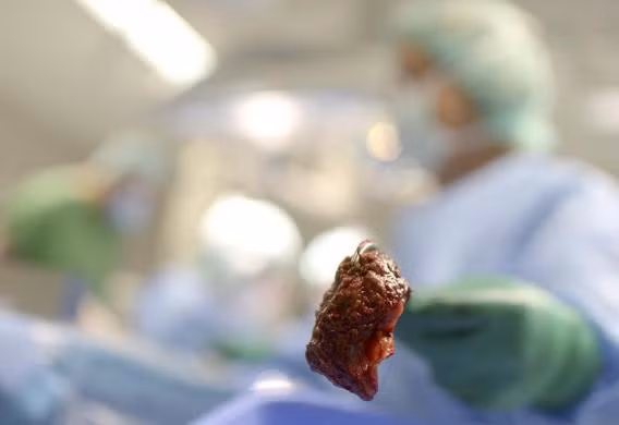 Mảnh khối u được lấy ra khỏi gan bệnh nhân.