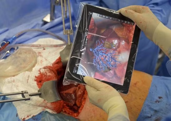 Chiếc máy tính bảng đang phân tích cấu trúc, vị trí khối u trong ca phẫu thuật.
