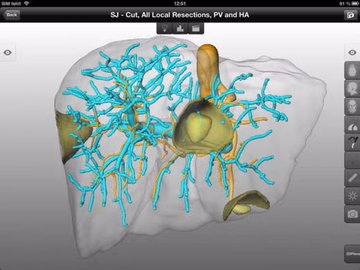 Mô hình tái tạo gan, tĩnh mạch cửa (màu lục lam), động mạch gan (màu cam) được phần mềm trong máy tính bảng phân tích.