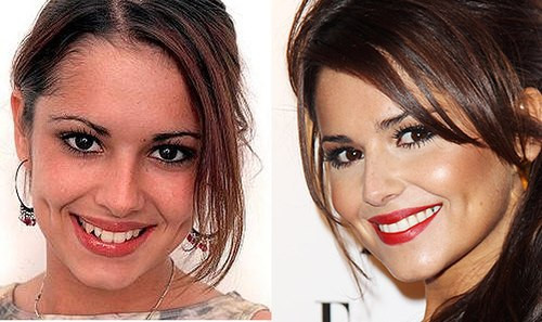 Ca sĩ nhạc Pop người Anh, Cheryl Cole ngày trước có hàm răng với những chiếc to nhỏ không cân đối và thẳng hàng. Bằng sự can thiệp của các biện pháp nha khoa, nữ ca sĩ giờ đã có hàm răng đẹp chuẩn chẳng kém gì trên quảng cáo kem đánh răng.
