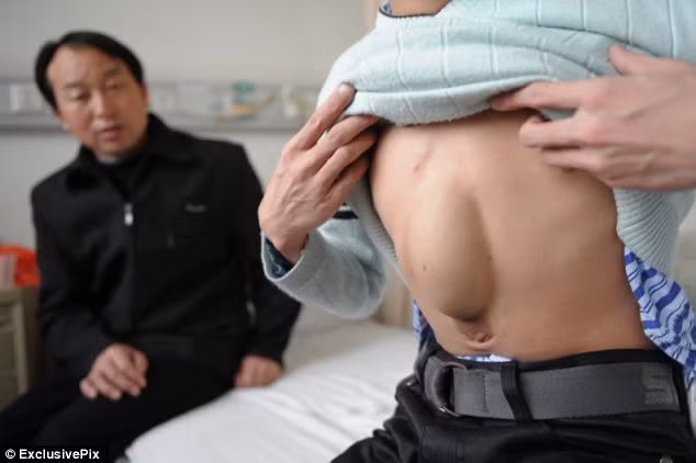 Trái tim lồi ra từ bụng anh Huang.