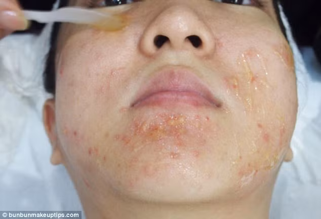 Nhìn thấy gương mặt của Juli, một bác sĩ của salon chỉ đơn giản nói cô có làn da quá nhạy cảm. Nếu chọc mủ nơi có những nốt mụn thì mọi thứ sẽ trở lại như cũ.