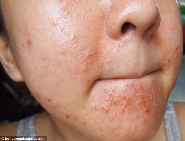 Những nốt mụn sau khi đã được chọc mủ.