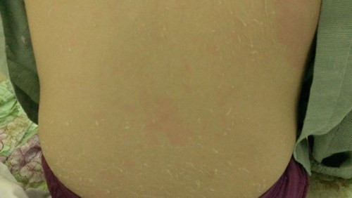 Ở Việt Nam, nhiều bệnh nhân đã phải nhờ đến sự trợ giúp của bác sĩ vì dại dột tự tắm trắng. Một trong đó là trường hợp của N.T.V, 21 tuổi, mới tốt nghiệp một cao đẳng kế toán trên địa bàn Hà Nội bị lột da do tự bôi kem tắm trắng mua trên mạng.