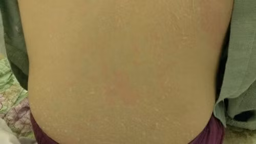 Ở Việt Nam, nhiều bệnh nhân đã phải nhờ đến sự trợ giúp của bác sĩ vì dại dột tự tắm trắng. Một trong đó là trường hợp của N.T.V, 21 tuổi, mới tốt nghiệp một cao đẳng kế toán trên địa bàn Hà Nội bị lột da do tự bôi kem tắm trắng mua trên mạng.