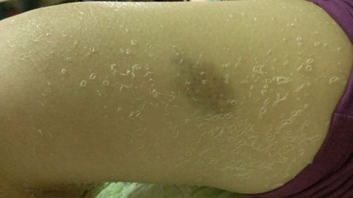 Sau vài giờ bôi không chịu đựng được, V đã báo người thân đưa đi cấp cứu tại Bệnh viện Trung ương quân đội 108, vào tối 6/8.