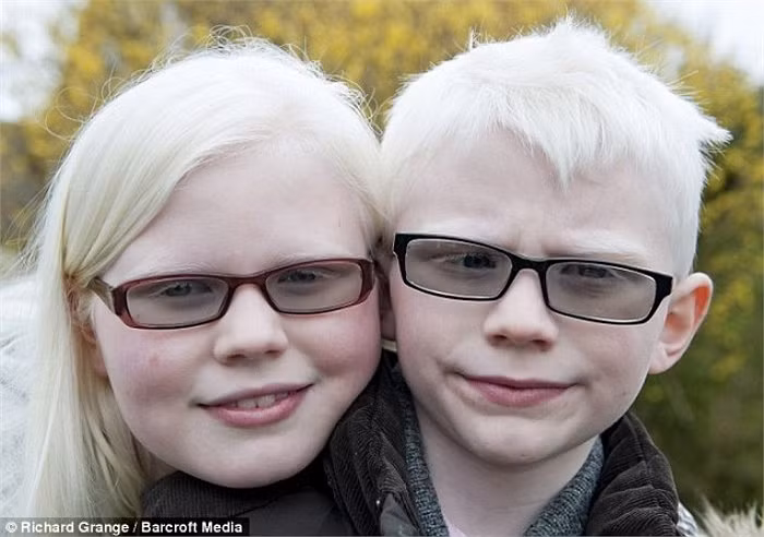 Căn bệnh khiến cơ thể của bé Ben (7 tuổi), và người chị tên Jessica (11) trở nên kỳ dị, ảnh hưởng nghiêm trọng đến da, tóc và cặp máu của 2 bé.