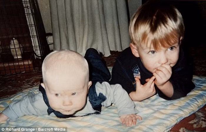 Người anh cả phát triển khoẻ mạnh bình thường và cậu em không may mắc bệnh bạch tạng