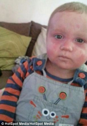 Kể từ sau khi được cấy ghép tủy xương, hệ thống miễn dịch của Leighton đã bị vô hiệu hóa