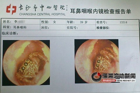 Ảnh chụp cận cảnh con nhện trong tai bệnh nhân.