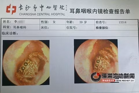 Ảnh chụp cận cảnh con nhện trong tai bệnh nhân.