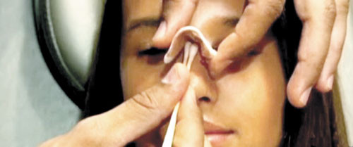 Nicolette được phẫu thuật sửa mũi - Ảnh: ABC News