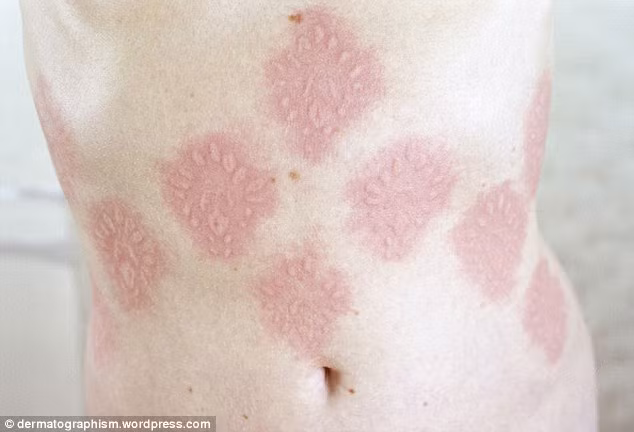 Căn bệnh khiến da của cô trở nên mẫn cảm.