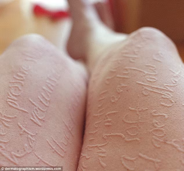 Tuy nhiên, chính căn bệnh kỳ lạ này, chị Russell đã nảy ra một ý tưởng táo bạo, đó là tạo nên những tác phẩm nghệ thuật ngay trên làn da của mình.