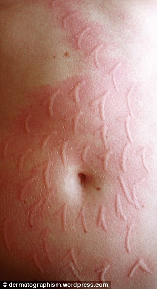 Tuy nhiên gần đây, các bác sĩ đã khuyến cáo căn bệnh của chị có dấu hiệu xấu đi, những vết đỏ, vết phòng rộp ngày càng xuất hiện nhiều trên cơ thể của chị Russell.