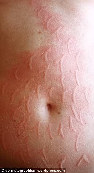 Tuy nhiên gần đây, các bác sĩ đã khuyến cáo căn bệnh của chị có dấu hiệu xấu đi, những vết đỏ, vết phòng rộp ngày càng xuất hiện nhiều trên cơ thể của chị Russell.