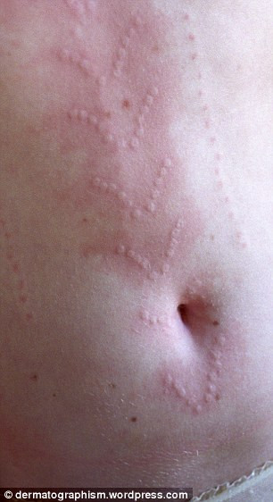 Nguyên nhân chính xác của căn bệnh trên vẫn chưa được làm rõ, chỉ biết nó ảnh hưởng đến khoảng 5% dân số thế giới, chủ yếu là ở lứa tuổi thanh thiếu niên.