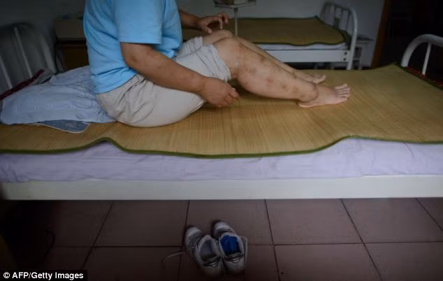 Bệnh nhân nghỉ ngơi sau khi đã được điều trị cho ong đốt, những vết sưng tấy còn nguyên trên chân.