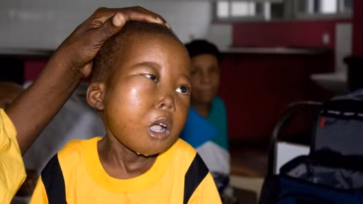 Virus EBV VÀ ung thư lympho Burkitt (u lympho ác tính) xảy ra ở trẻ em Châu Phi cao gấp 40 lần trẻ em ở Mỹ.