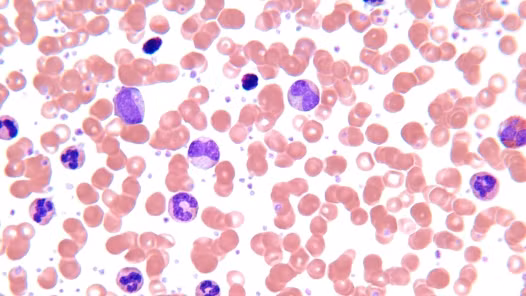 Virus HTLV-1 gây ung thư bạch cầu lympho ác tính. Đây là một loại ung thư máu có ảnh hưởng đến các tế bào bạch cầu chưa trưởng thành từ tủy xương. Nhiều chứng cứ cho rằng HTLV-1 có thể gây bệnh bạch cầu cấp.