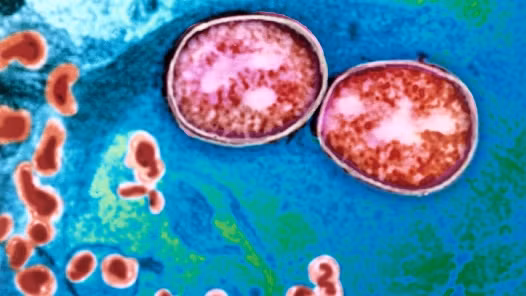 Ung thư âm đạo do virus HPV gây ra. Virus gây mụn cóc sinh dục cũng có liên quan đến ung thư âm đạo, nhưng ở mức độ thấp hơn, bởi ung thư âm đạo là một trong những căn bệnh tương đối hiếm gặp.