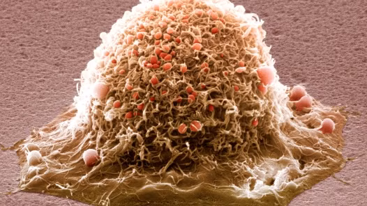 Virus HPV gây ung thư cổ tử cung. Nhiều người nghĩ ung thư chẳng liên quan gì đến bệnh truyền nhiễm; điều đó không đúng với ung thư cổ tử cung. Virus gây u nhú vùng sinh dục - HPV - có thể dẫn đến bệnh này. Vì vậy, quan hệ tình dục không an toàn đồng nghĩa với việc truyền nguy cơ ung thư cho người khác.