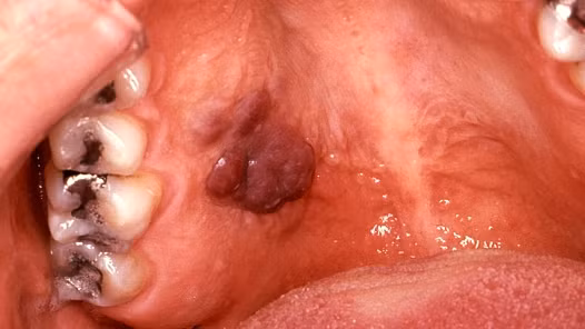 Ung thư Kaposi sarcoma và virus HIV. Ung thư Kaposi sarcoma là một khối u ác tính, thường xuất hiện trên da. Nó phát triển trong các mạch bạch huyết mạng lưới vận chuyển của hệ miễn dịch. Bệnh thường thấy ở những người nhiễm HIV hoặc được cấy ghép cơ quan nội tạng. Do đó, nó làm hệ miễn dịch suy yếu.