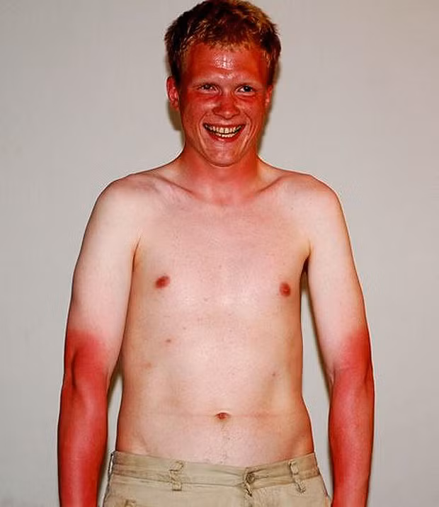 Cháy nắng đến thành "tôm luộc" thế này có lẽ rất hiếm. Chàng trai này hẳn đã mặc một chiếc áo phông cộc tay tắm nắng nên mới thành ra như thế này.