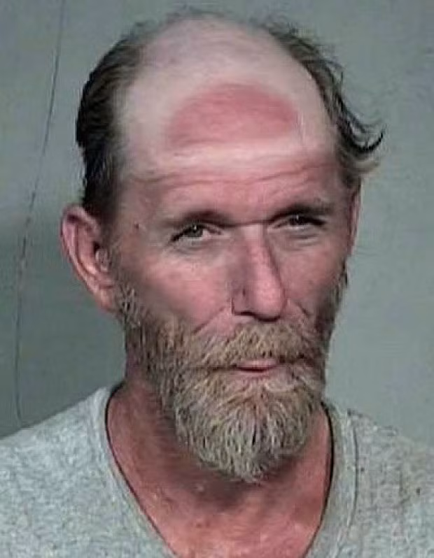 Chỉ vì đội mũ lưỡi trai ngược mà đầu ông này để lại dấu vết cháy nắng rõ rệt.