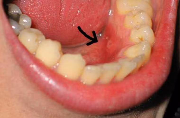 Đi tìm dấu vết khối u. Những khối u này đôi khi không hề mang lại cảm giác đau đớn cho khổ chủ. Chính vì vậy, bạn cần phải đặc biệt chú trọng đến các dấu hiệu như khối u lồi lên với màu nhạt hoặc trắng.