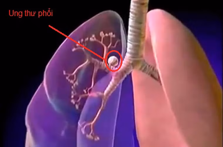 Ngoài ra, các nhà nghiên cứu Nhật Bản cũng khẳng định việc tiêu thụ bí ngô, rau xanh, trái cây và sữa thường xuyên còn giúp giảm nguy cơ mắc ung thư phổi.