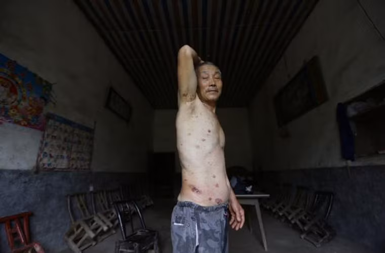 Ông Gong Zhaoyuan, 69 tuổi được chẩn đoán mắc ung thư da. Những dấu tích của căn bệnh chằng chịt trên cơ thể của bệnh nhân. Các bác sĩ khẳng định nguyên nhân mắc bệnh của Zhaoyuan là do nhiễm độc asen.